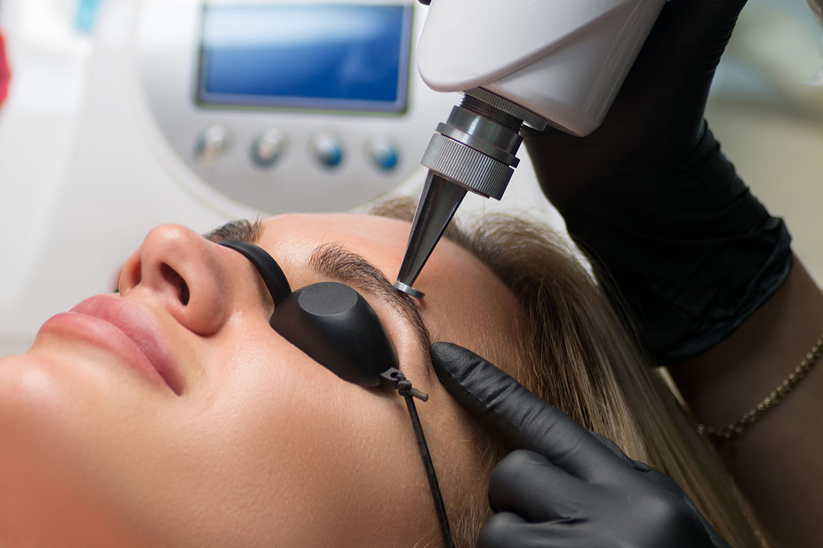 Antakių permanento šalinimas lazeriu